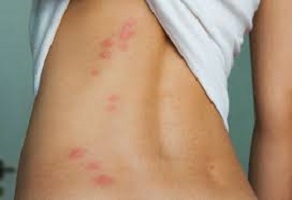 Меня укусили!