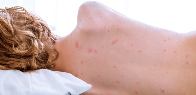 Підривник імунітету! Вірус кору