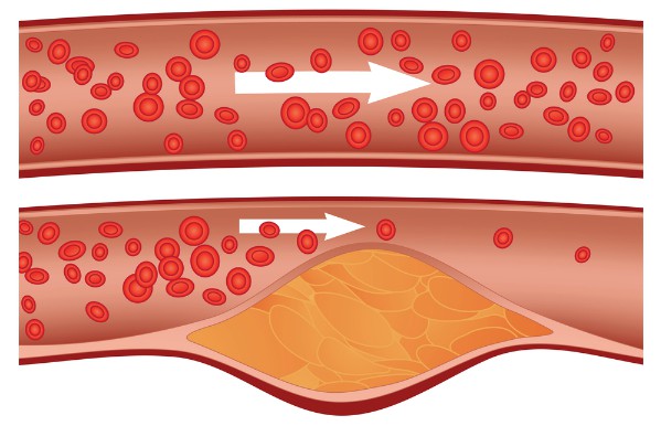 Ніякий не ворог. Формула хорошого холестерину