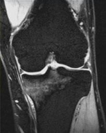 Стресс-перелом.. - 1