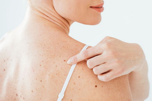 Что нужно знать о меланоме?