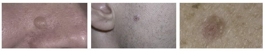 Навіщо потрібен плановий огляд онколога, або що потрібно знати про рак шкіри - 1