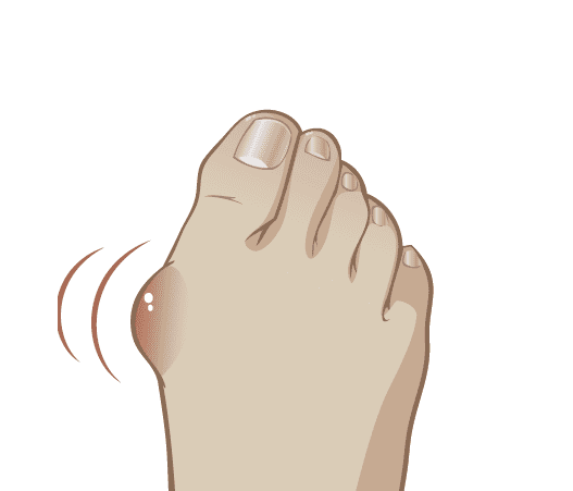 «Косточки» на ногах