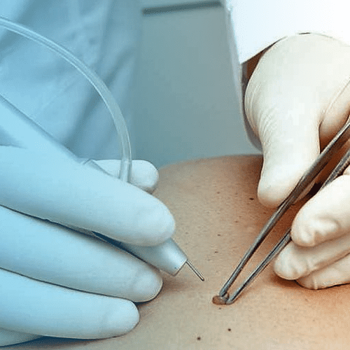 Радіохвильове видалення новоутворень