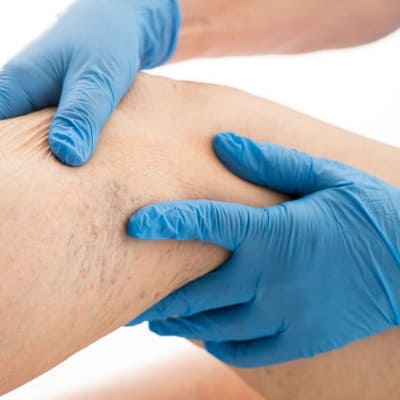 Чек-Ап (Check-Up) «Варикоз»: збережіть легкість та здоров’я ваших ніг