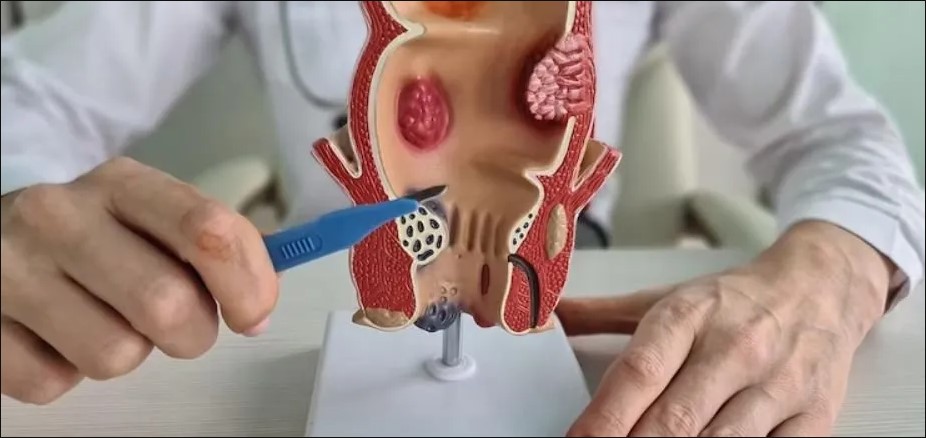 Проктологія