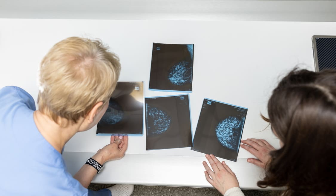 Профілактика раку молочної залози