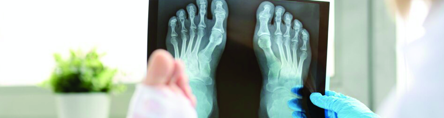 Рентгенография стопы