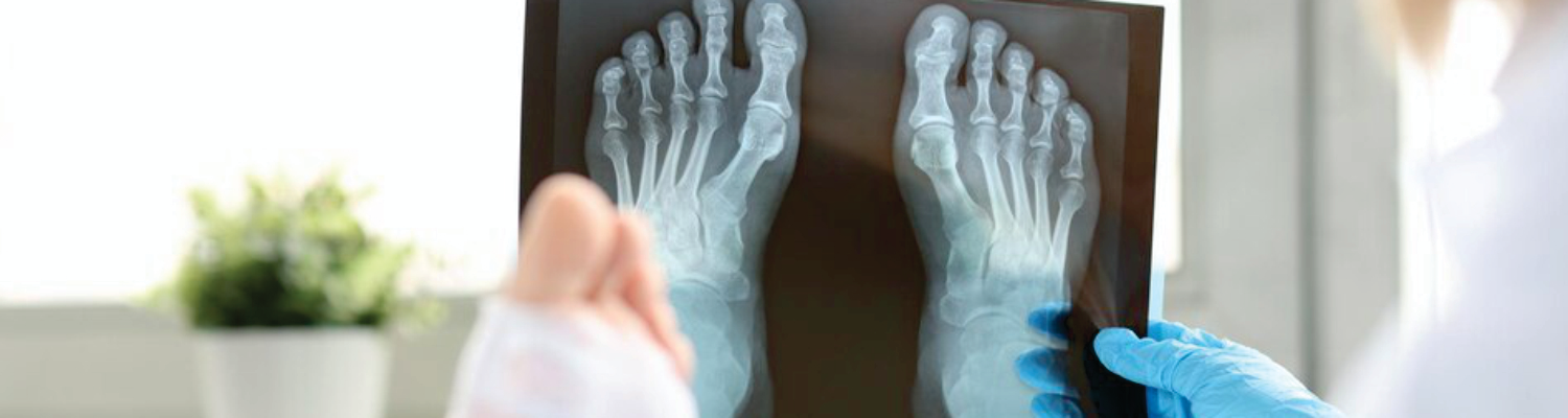 Рентгенография стопы