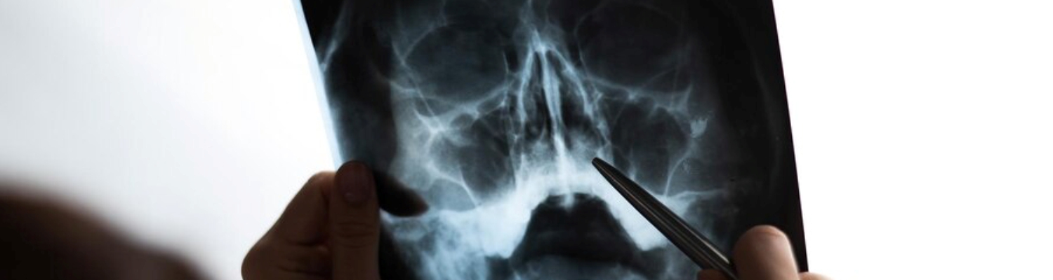 Рентгенографія придаткових пазух носа