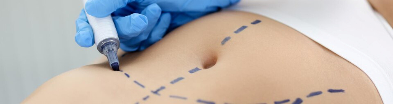 Абдомінопластика